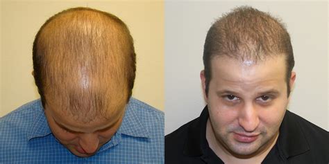Completely Bald Patient Dramatically Changes His Appearance Dr Brett