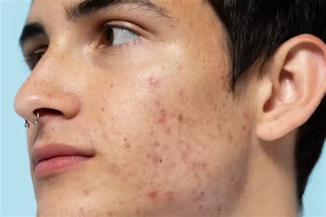 Best Skin Treatments For Acne Scars As Suggested By Dermatologists