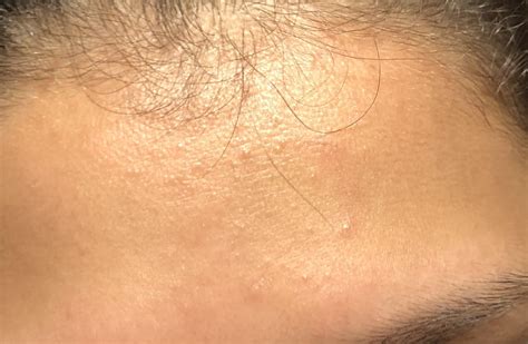 Tiny Flesh Colored Bumps General Acne Discussion Forum