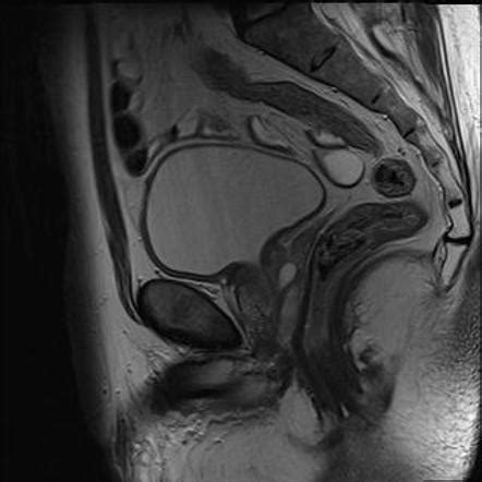 Müllerian duct cyst Radiology Reference Article Radiopaedia org