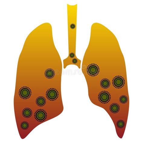 Human Lungs With Pneumonia Stock Vector Illustration Of Isolated
