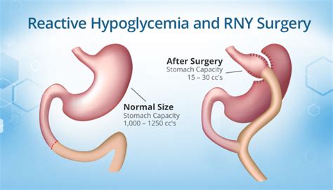 Reactive Hypoglycemia After Rny Causes Signs And Treatments