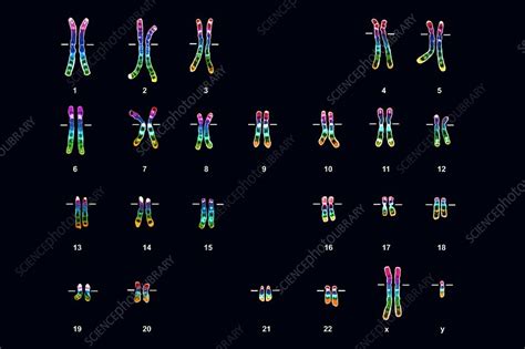 Klinefelter S Syndrome Karyotype Male Stock Image C