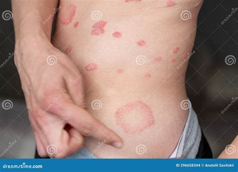 Psoriasis Vulgaris Skin Patches Are Typically Red Itchy And Scaly