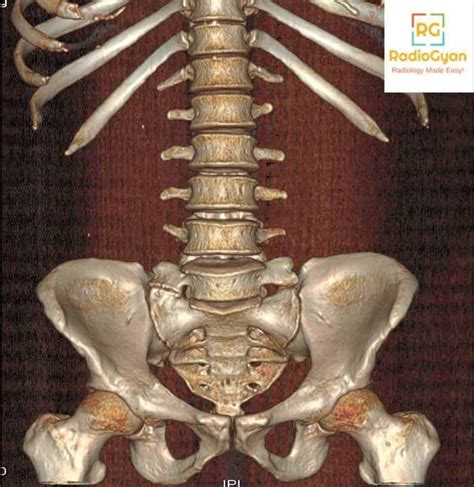 Normal Anatomy Variants Radiology Cases Radiogyan