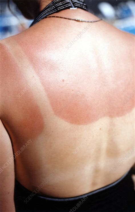 Sunburned Skin Stock Image M335 0238 Science Photo Library