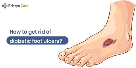 Signs And Symptoms Of Diabetic Foot Ulcer Pristyn Care