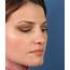 Healing After Closed Rhinoplasty Nosejob In San Diego By Nose 
