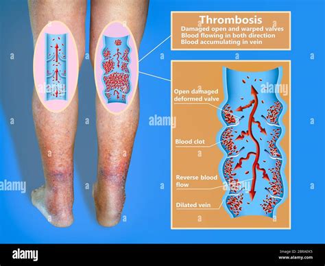 Deep Vein Thrombosis Or Blood Clots Embolus Structure Of Normal And