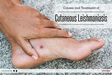 Causes And Treatment Of Cutaneous Leishmaniasis By Dr Ravindranath Reddy Lybrate