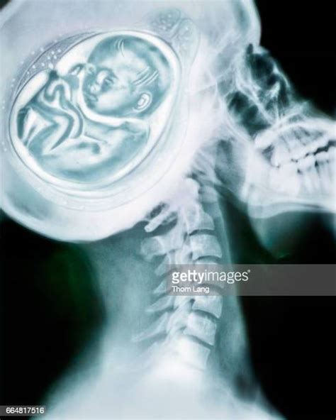 Baby X Ray Photos And Premium High Res Pictures Getty Images