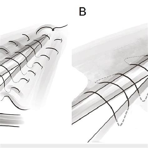 Schematic Illustration Of Commonly Used Suture Patterns In Mucosal