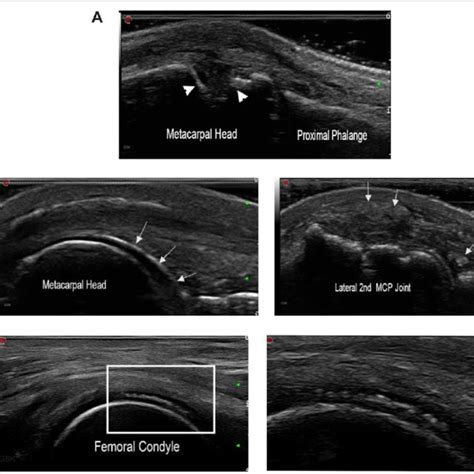 Ultrasound Imaging Of Enthesitis A Achilles Enthesophyte In A Patient