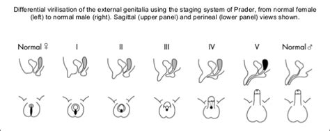 disorders of sex development ambiguous genitalia journal of pediatric nursing nursing care of