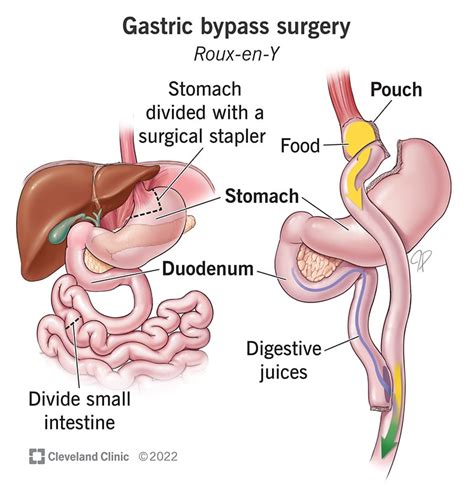 Gastric Bypass Roux En Y Surgery Requirements And Recovery
