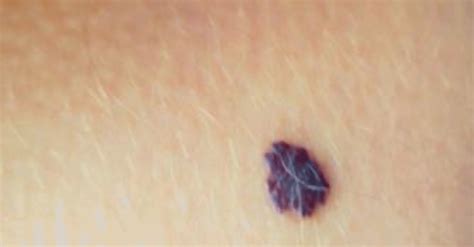 Cureus Solitary Angiokeratoma In A Young Man A Rare Case Report