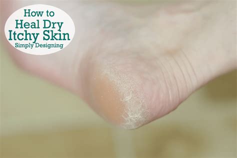 How To Heal Dry Itchy Skin