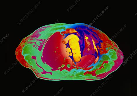Coloured Ct Scan Showing Collapsed Lobe Of Lung Stock Image M108