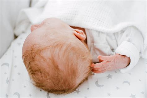 Newborn Facial Bruising Could Be A Birth Injury