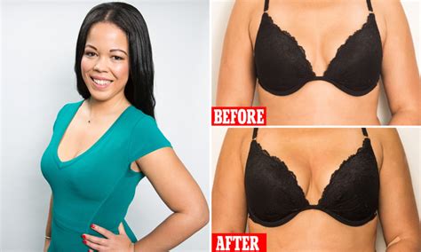 Before And After Vampire Breast Lift Cosmetic Surgery Tips