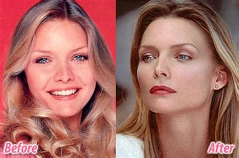 Stars Before And After Plastic Surgery 47 Pics