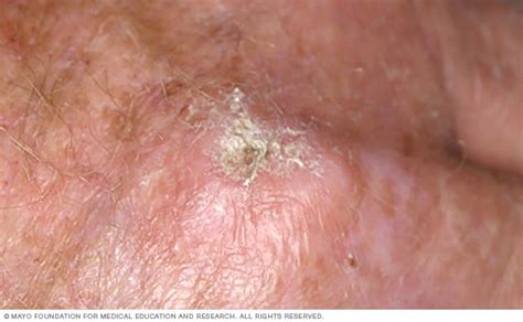 Actinic Keratosis Symptoms And Causes Mayo Clinic