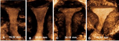 A Multicenter Study Assessing Uterine Cavity Width In Over Nulliparous Women With IUD Or