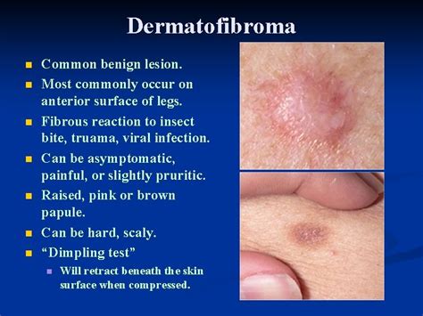 Dermatology For Primary Care Recognizing Common Skin Tumors