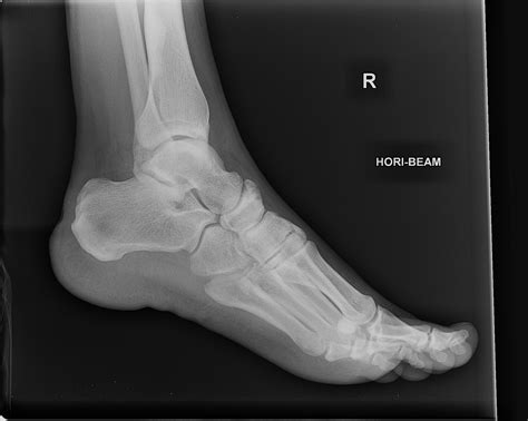 Lateral Foot X Ray Anatomy