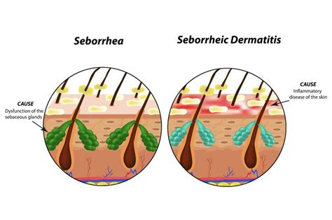 Zoom Sur La Dermatite Séborrhéique Du Cuir Chevelu Avec Le Cidp