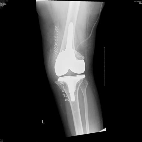 Joint Preservation And Replacement 3 Complex Knee Cases
