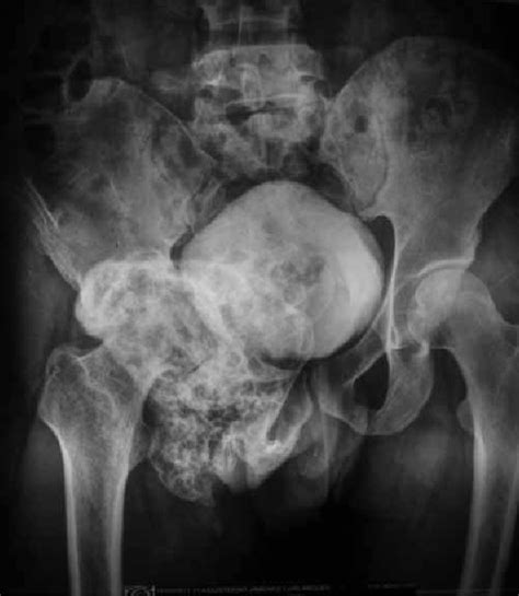 Ap Pelvic X Ray With Contrast Medium In The Bladder At Postoperative