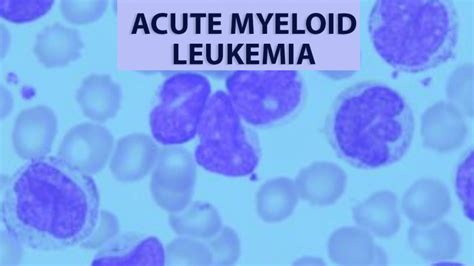 Acute Myeloid Leukemia Overview And Treatment Cancerconnect