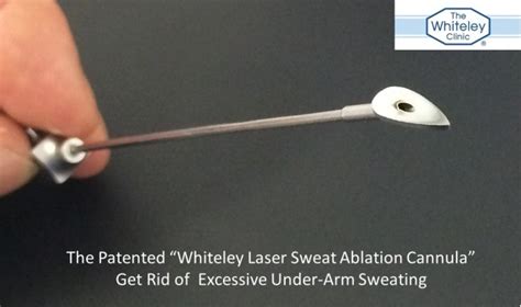 New Lsa Device For Underarm Sweating The Whiteley Clinic