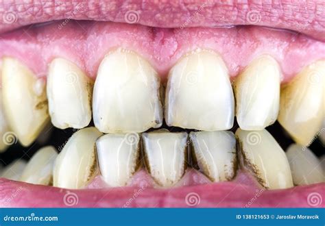 Dental Plaque On Teeth Stock Image Image Of Tooth Hygiene 138121653