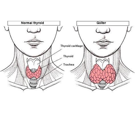 What Are The Symptoms Of Goiter 7 Steps