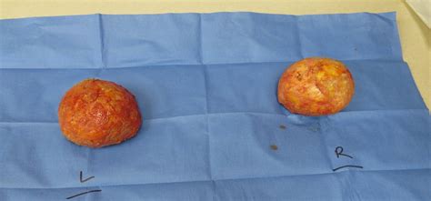 However, if you have a medical need for your breast augmentation it will likely be covered. Before and After Breast Implant Removal Photos
