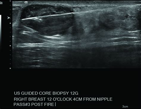 Epidermoid Cyst In Male Patient Mimicking A Suspicious Breast Mass And