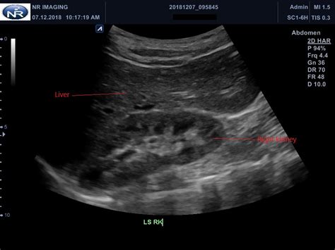 Kidney Ultrasound Labeled