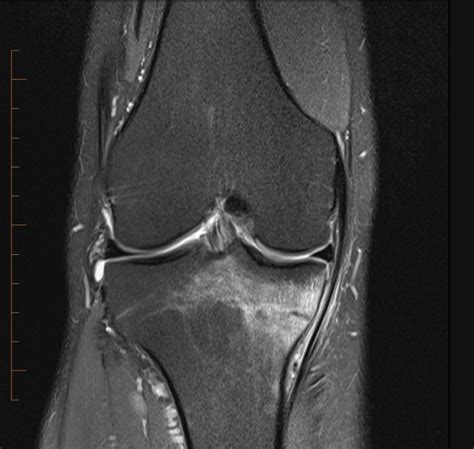 Mri Scan Knee Mri At Melbourne Radiology Clinic