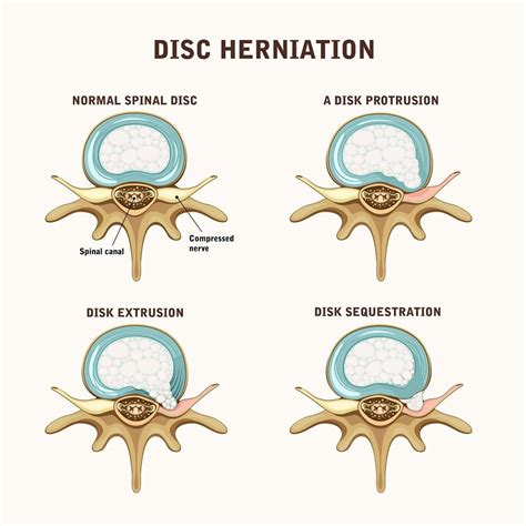 What Is The Difference Between A Disc Bulge And A Herniation Neuro My