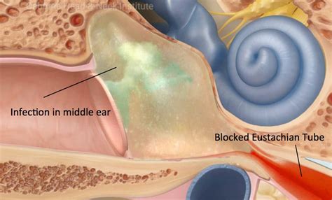 Eustachian Tube Dysfunction Ear Doctor Los Angeles Ca Top Otology