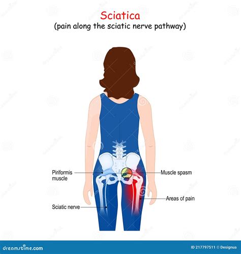 Sciatica Body Of A Patient Woman With Areas Of Pain From The Back