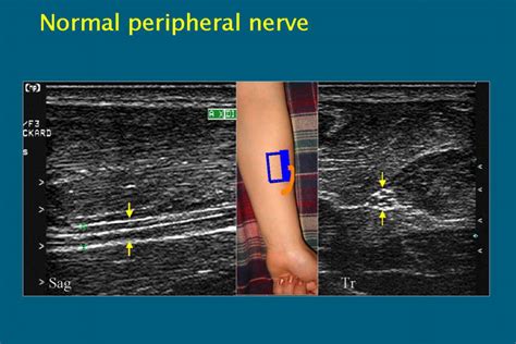 Peripheral Nerve Lesions Role Of High Resolution Us Radiographics