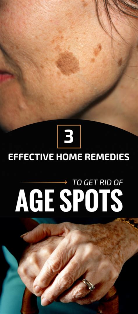 Pin By Beena Goswami On General Brown Spots On Face Spots On Face