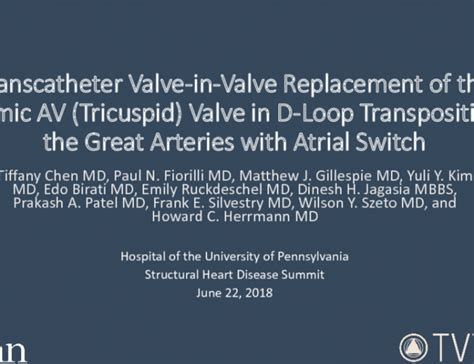 Transcatheter Valve In Valve Replacement Of The Systemic Av Tricuspid