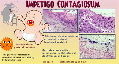 Pathology Of Impetigo Dr Sampurna Roy Md