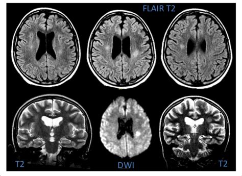 Mri Of Patient 6 Showing Hyperintensity Of The Deep White Matter On