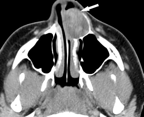 Masses Of The Nose Nasal Cavity And Nasopharynx In Children
