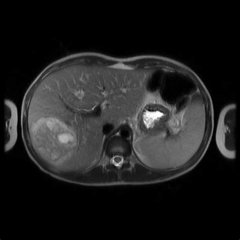 Radiology Cases Pyogenic Liver Abscess